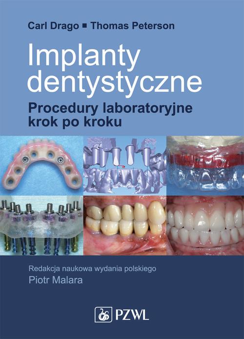 EBOOK Implanty dentystyczne. Procedury laboratoryjne krok po kroku