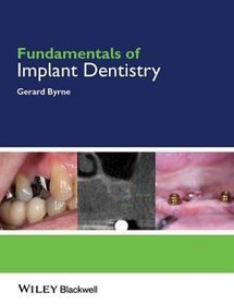 Fundamentals of Implant Dentistry