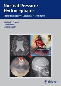 NHP - Normal Pressure Hydrocephalus: Pathophysiology-diagnosis-treatment