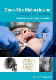 Open-Bite Malocclusion