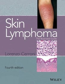 Skin Lymphoma